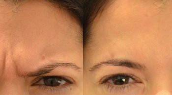 female patient's forehead before and after Botox for glabella