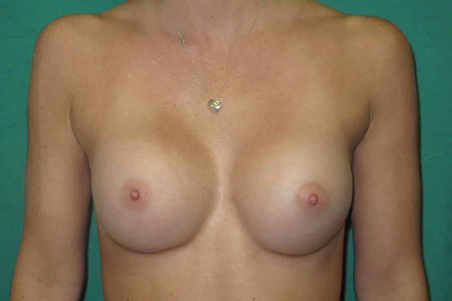 Patient After Breast Augmentation