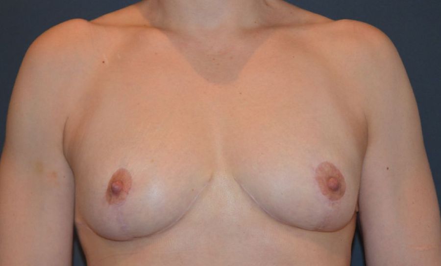 Patient After Breast Reduction