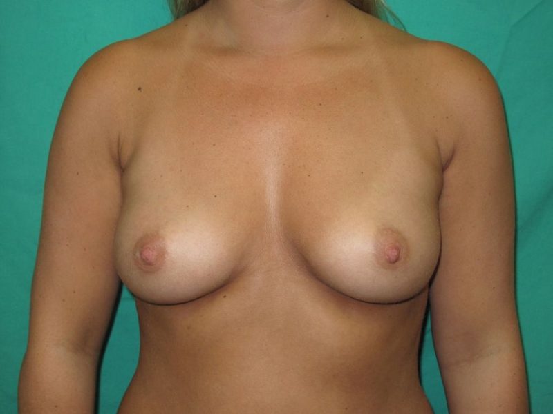 Patient After Removal of Underarms Procedure