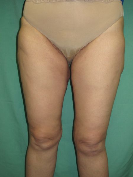 Patient After Thigh Lift
