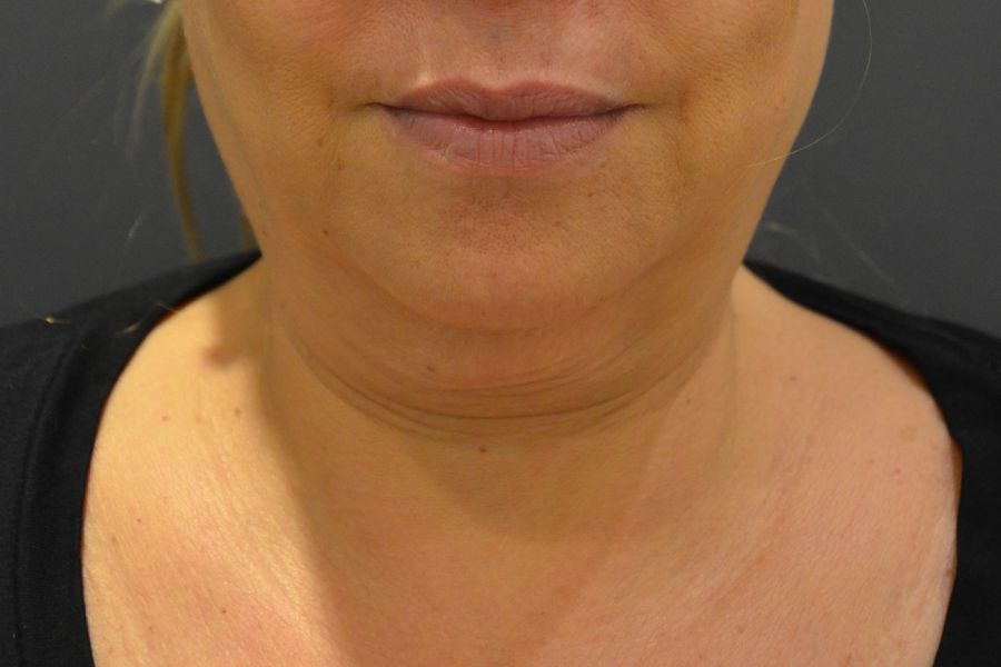 Patient Before Injection of Kybella
