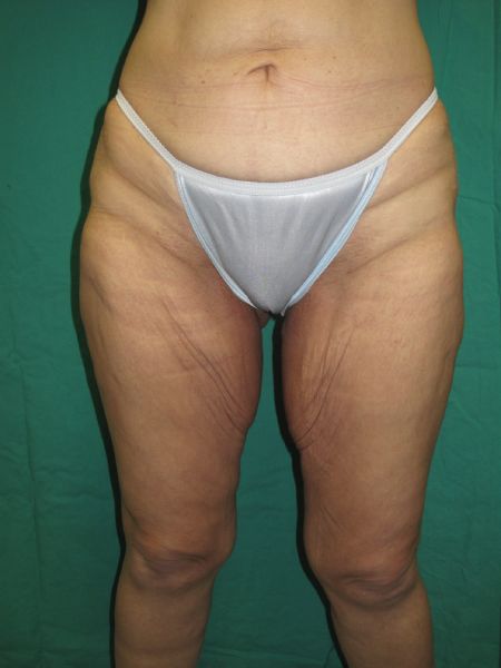 Patient Before Thigh Lift
