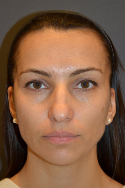 Female patient before nose plastic surgery