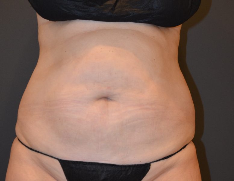 Female patient's abdomen and hips after Coolsculpting treatment