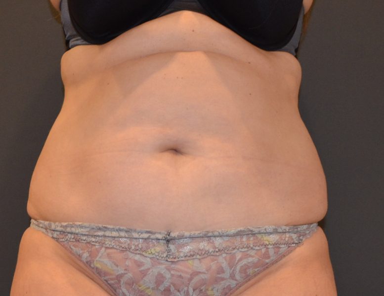 Female patient's abdomen and hips before Coolsculpting treatment
