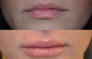 Patient's lips before and after lip augmentation.