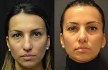 Female patient before and after plastic nose surgery.