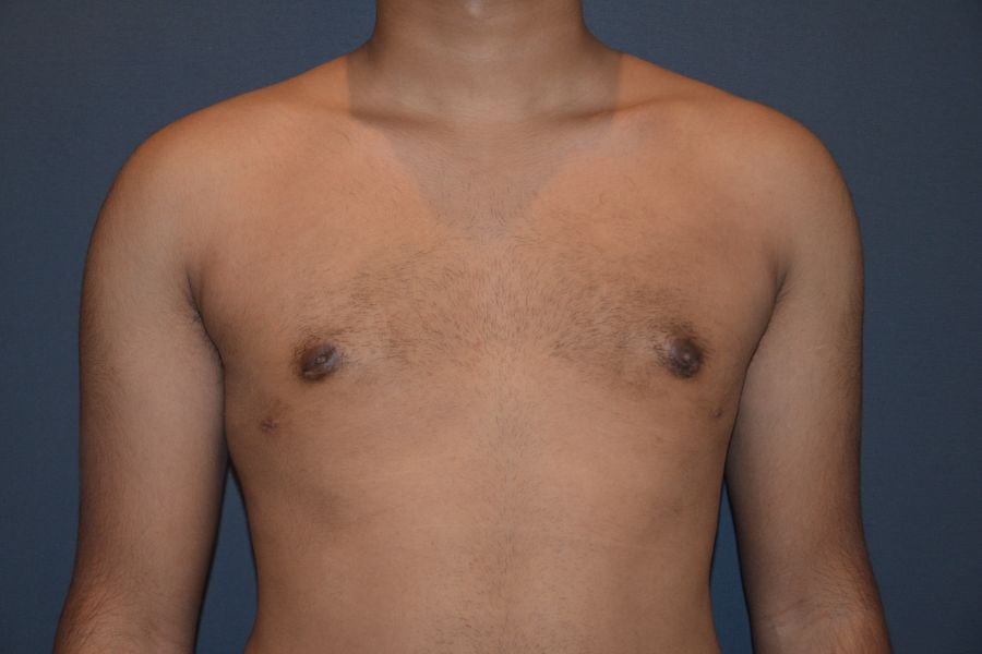 Patient After Male Breast Reduction