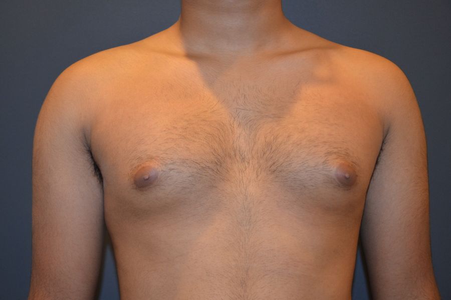 Patient Before Male Breast Reduction
