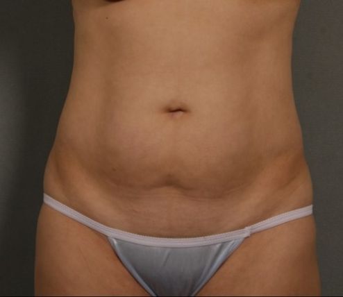 Patient Before Liposuction