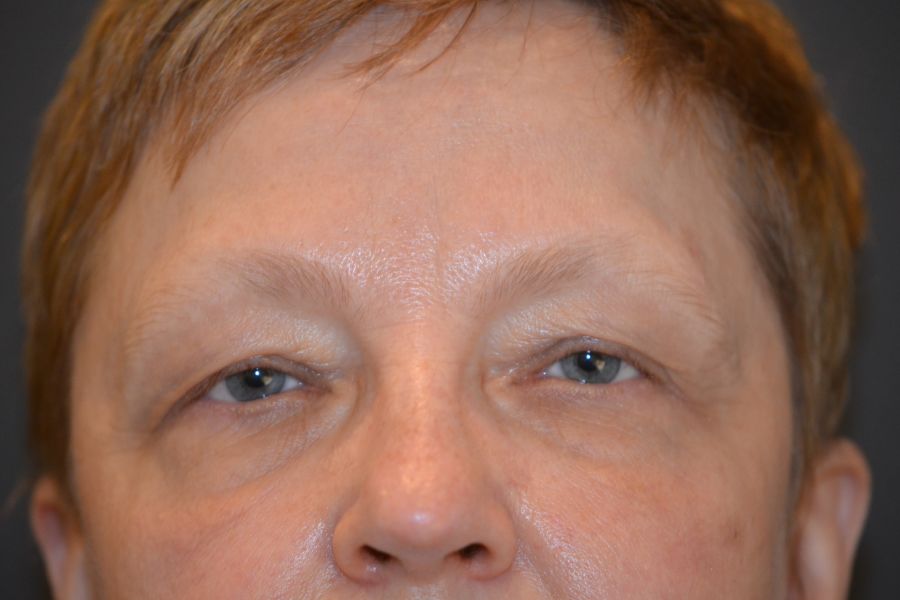 Patient Before Eyelid Surgery