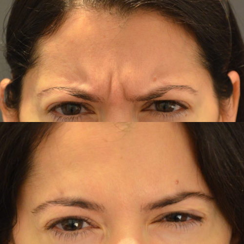🥇 NYC Face Laser Skin Resurfacing, Manhattan Laser Skin Rejuvenation