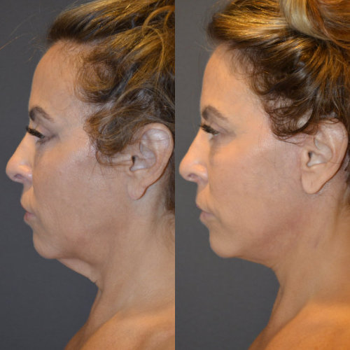🥇 NYC Facelift Surgery, Mini Face Lift