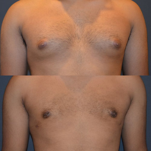 Male Breast Reduction/Gynecomastia New York City