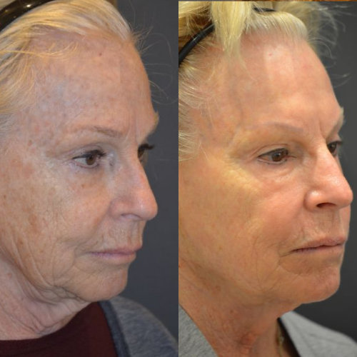 🥇 NYC Face Laser Skin Resurfacing