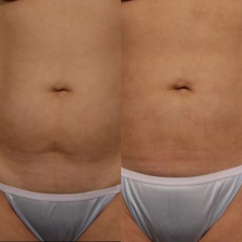 Is Liposuction Permanent? What You Need to Know - Clinic 360