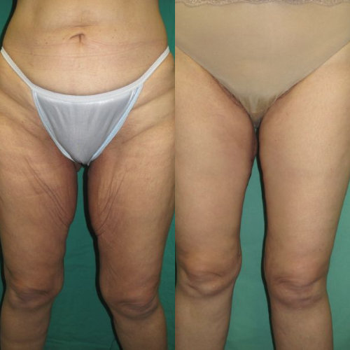 Anterior Thigh Liposuction or Lift: Which To Opt For