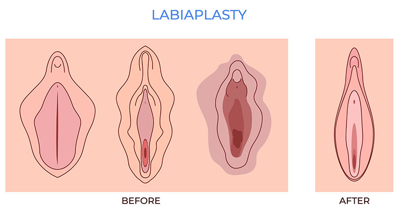 labiaplasty labiaplasty