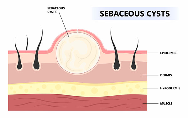Cross-section diagram of skin layers showing a sebaceous cyst beneath the epidermis, with labels for epidermis, dermis, hypodermis, and muscle.