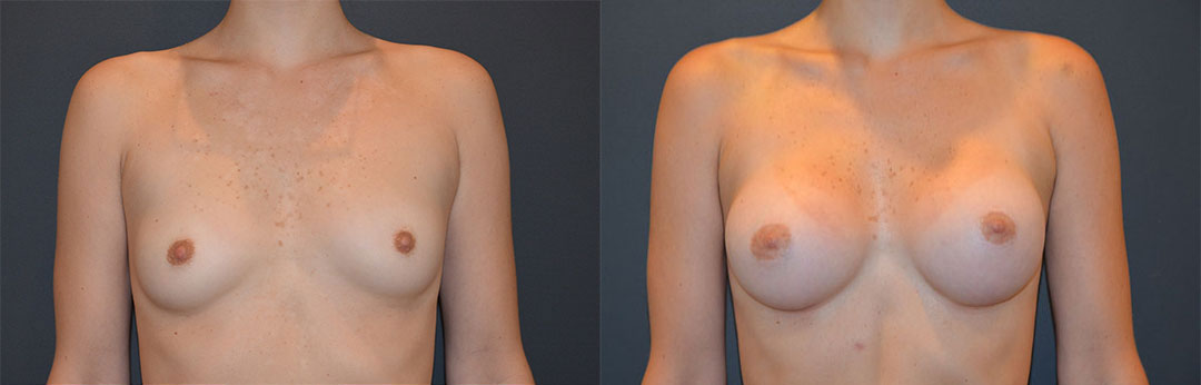 Breast Aug front
