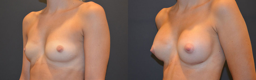 Breast Aug side