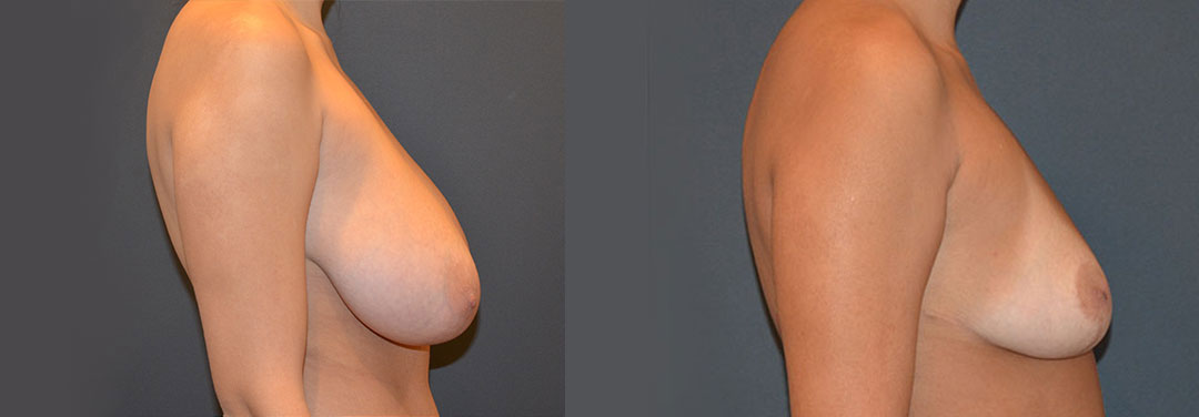 Breast Reduction