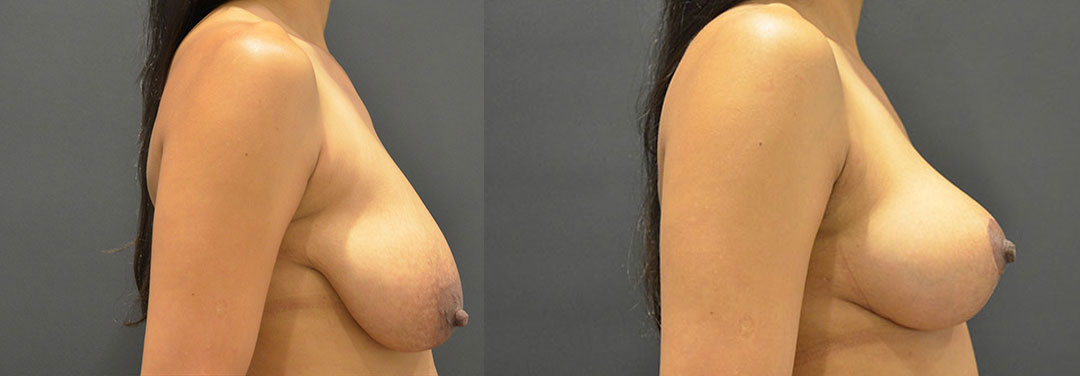 Breast Lift