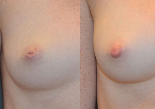 Inverted nipple repair