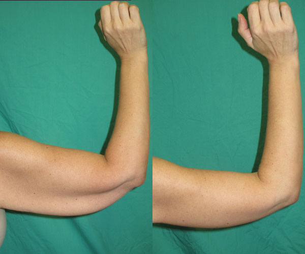 armlift before and after photo