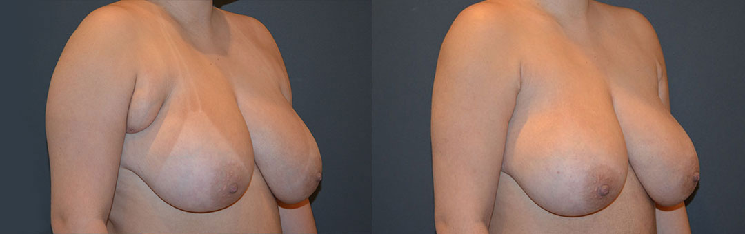 axillary breast tissue removal