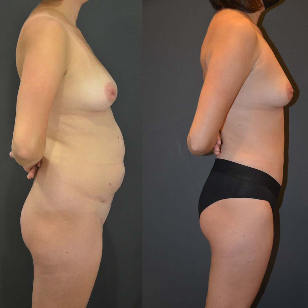 diastisis diastisis before and after