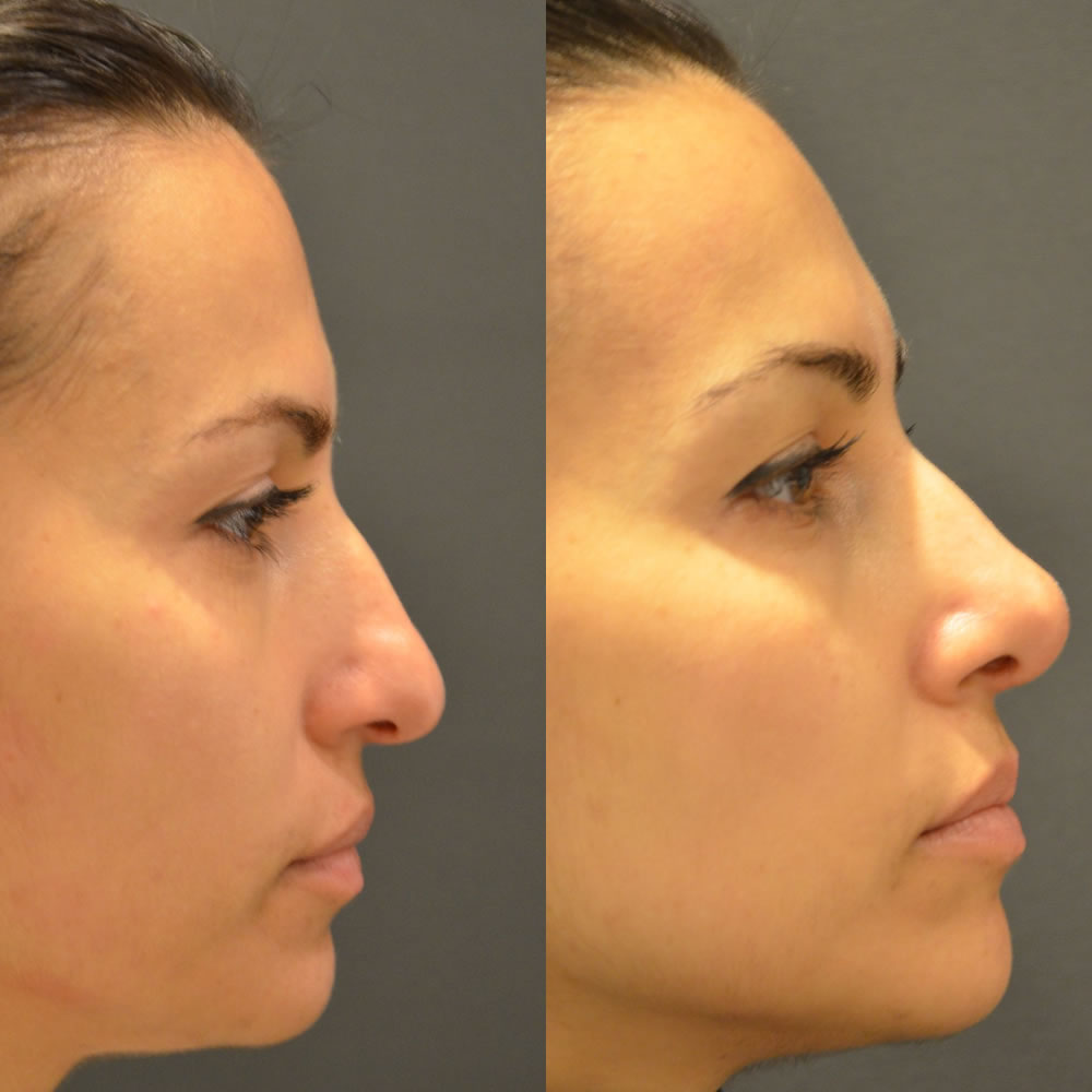 Rhinoplasty Before and after