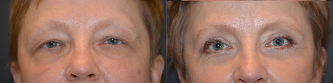blepharoplasty