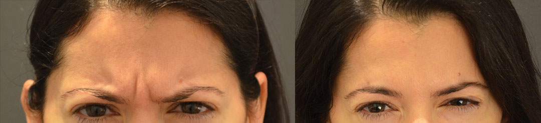 botox before after