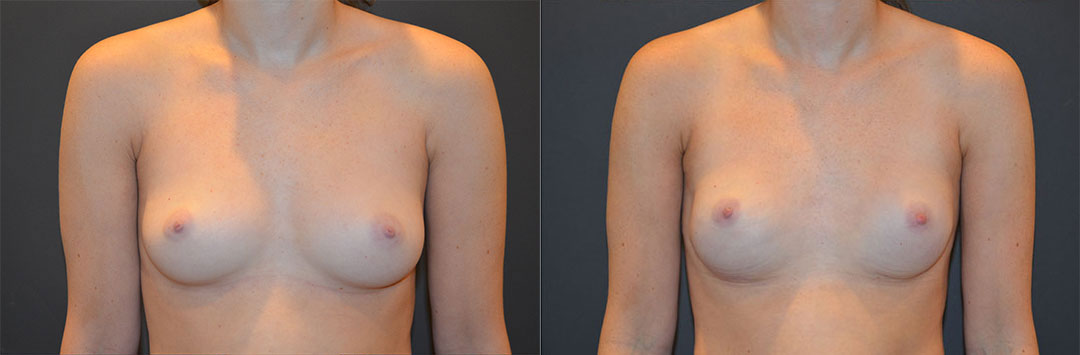 breast reconstruction