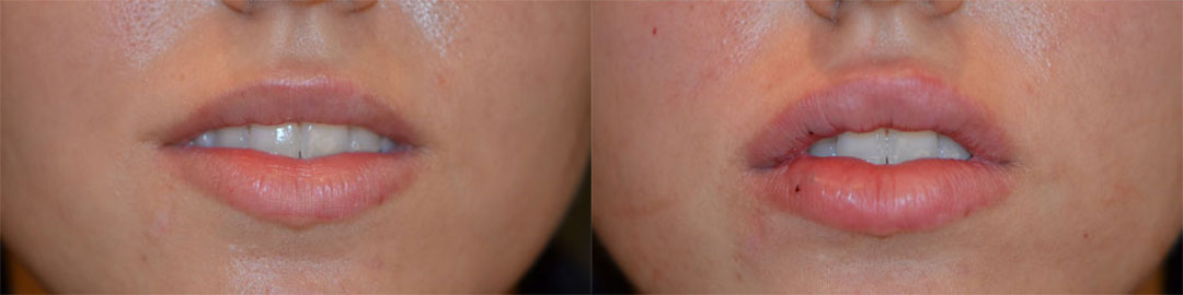 lip filler