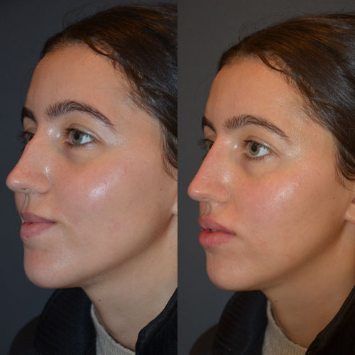 nose filler liquid rhinoplasty