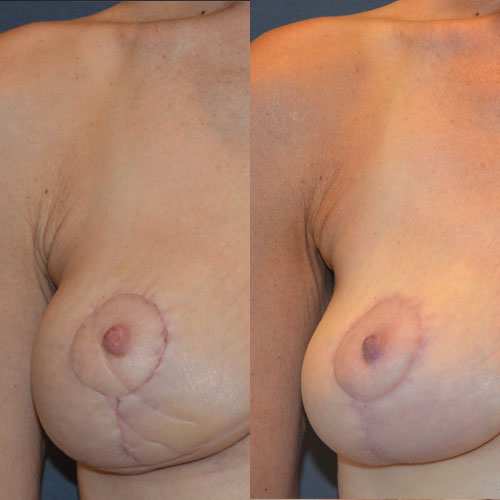 scar removal before and after photos