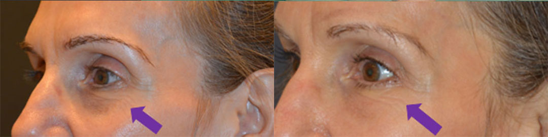 undereye filler