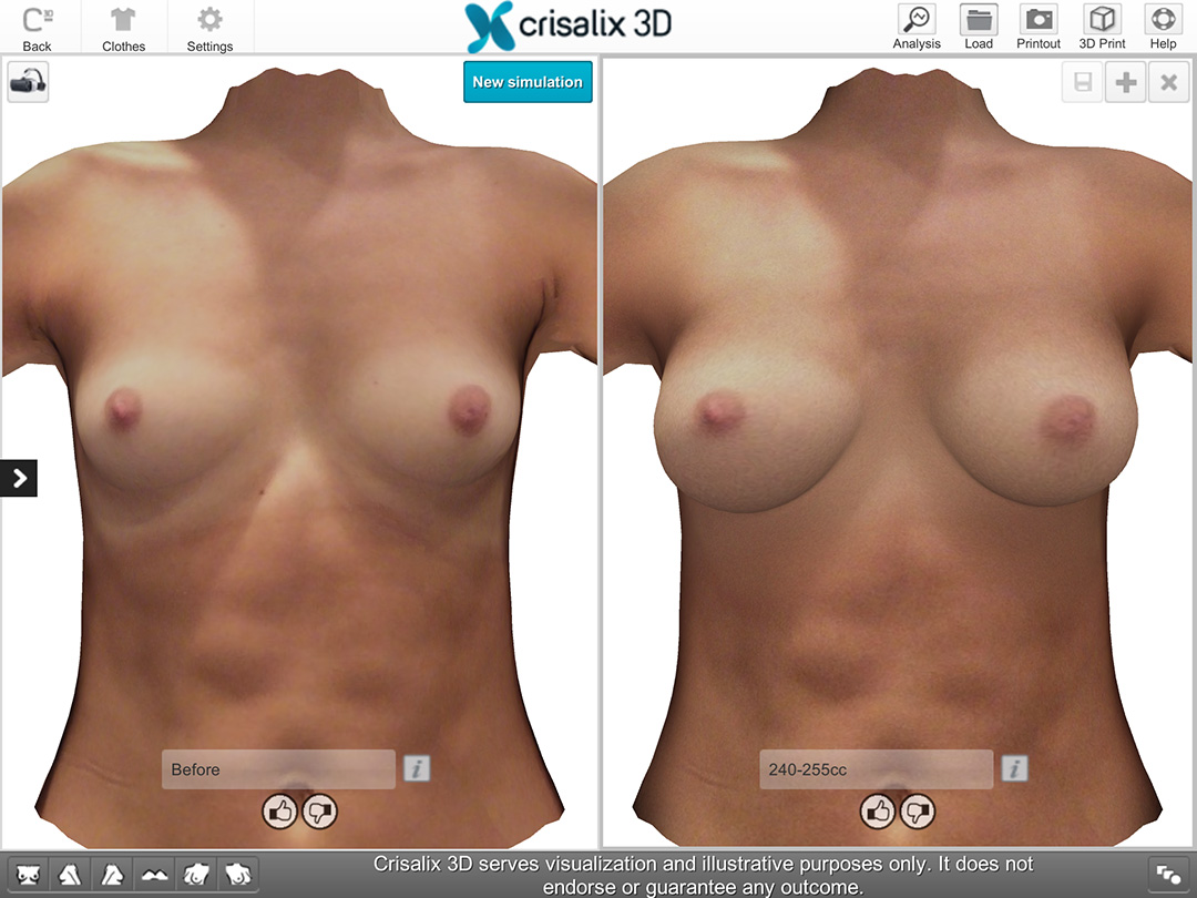 3D Imaging Crisalix 3D serves visualization and illustative purposes only. It does not endorse or guarantee any outcome.