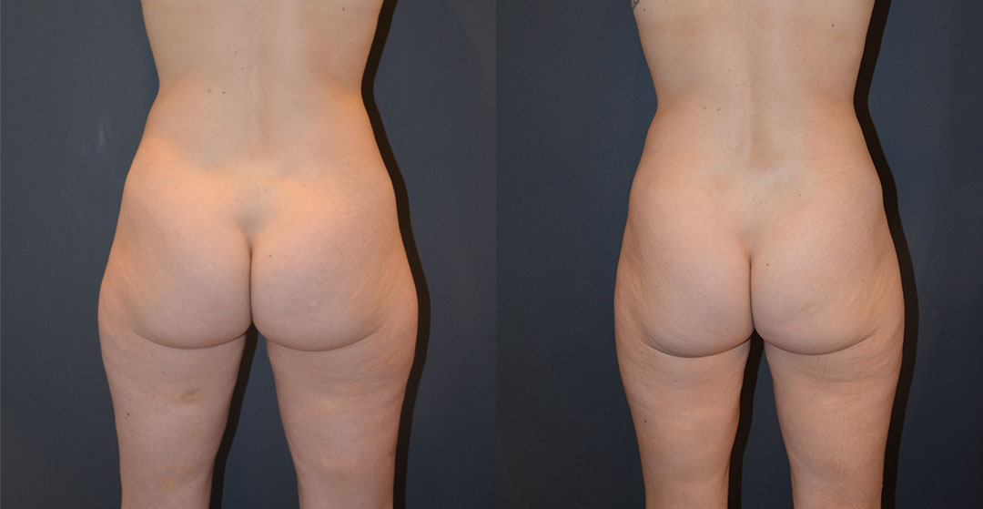 before and after Bodytite Lipo procedure