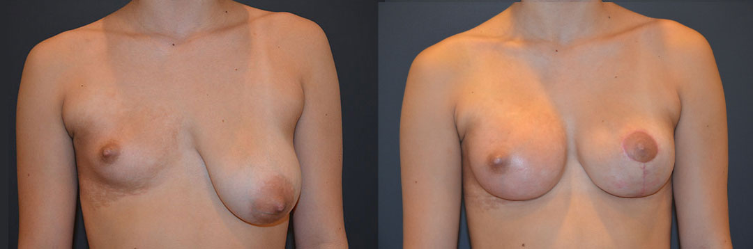 Breast Asymmetry