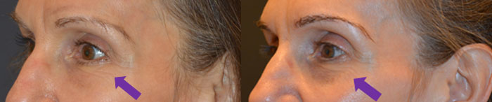 Side-by-side comparison of the same person's face showing wrinkle reduction around the eyes, with purple arrows pointing to the area of change.