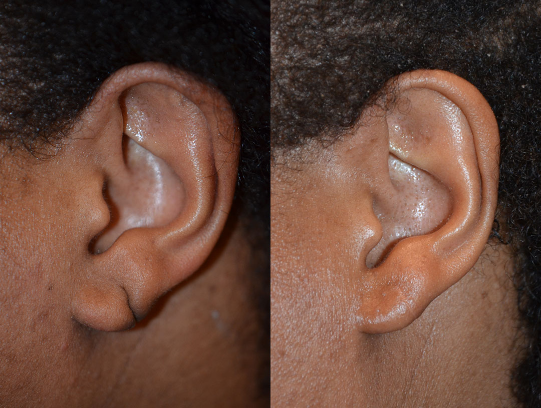 Close-up view of two human ears after earlobe repair