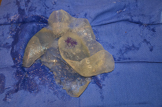 Silicone breast implant lying on a blue medical cloth.