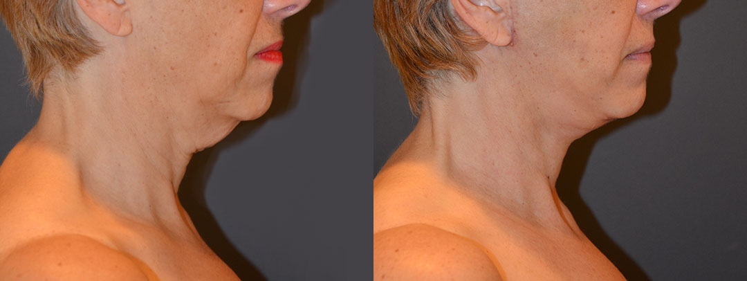 Side-by-side profile images of a woman's neck before and after treatment, showing a noticeable reduction in sagging and improved skin tightness.