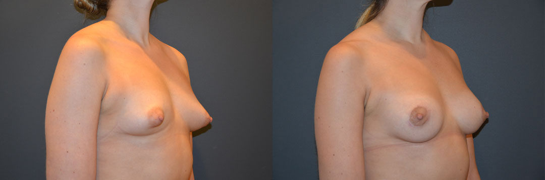Two side-by-side images of a woman's bare chest before and after breast enhancement surgery, showing an increase in breast size and shape improvement.
