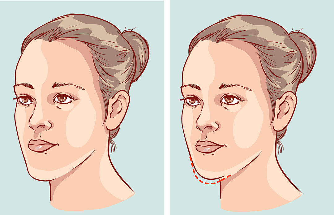 Illustration showing a woman before and after a cosmetic chin procedure, indicated by red dashed lines.