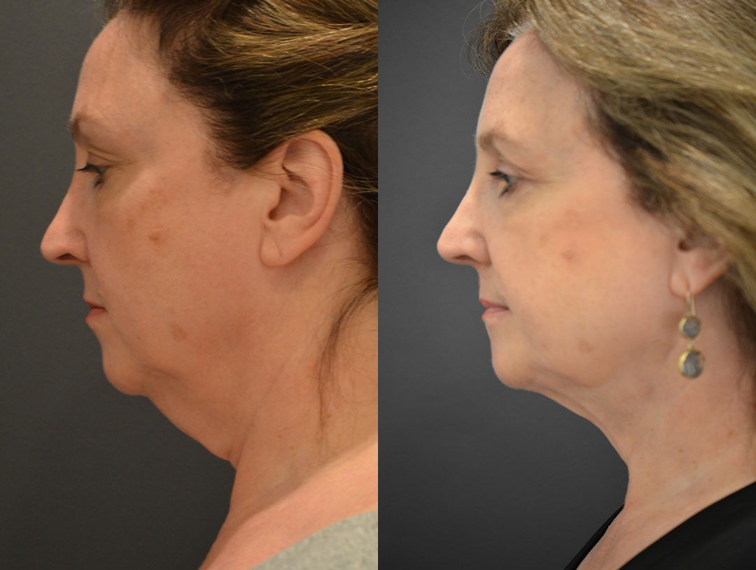 chin liposuction - before and after photo
